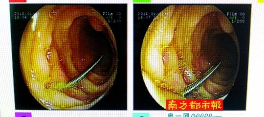 家长给未满周岁男婴做针灸 致男婴误吞钢针20天无人知(组图)