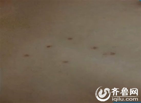 濱州多名幼童現疑似針扎傷痕 公安調查：傷痕非扎傷(圖)