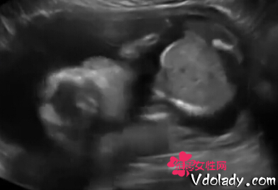 子宮內胎兒自打臉 小拳揮動KO自己（組圖）