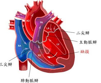 男童心臟動脈長反 病例僅1%成功率估計八成（組圖）