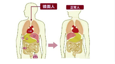 6歲男孩臟器都長反 “鏡面人”出生率百萬分之一