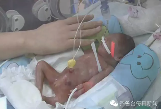 23周早産嬰兒個頭和護士手掌差不多大（圖片來源：每日新聞微信）