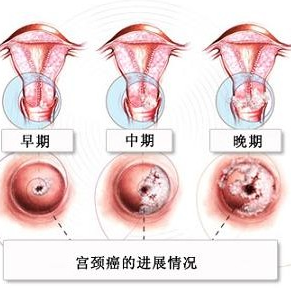 女子三年交15名男友失去生育能力 如何降低宮頸癌發病率（組圖）