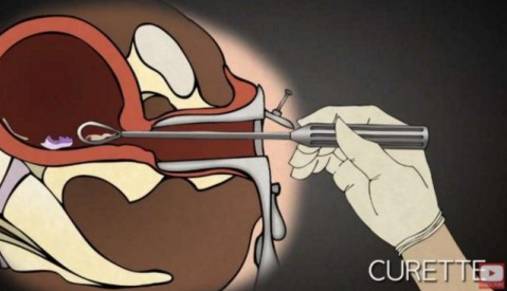 墮胎手術過程令人髮指！醫生辭職用影片揭秘恐怖真相(組圖)
