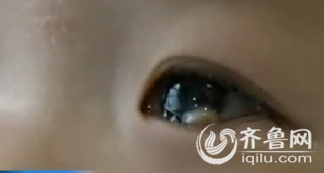 濟南：11月大女嬰患角膜皮樣瘤 靠移植豬角膜保住眼睛