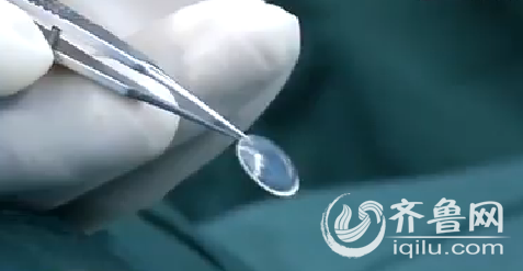 濟南：11月大女嬰患角膜皮樣瘤 靠移植豬角膜保住眼睛