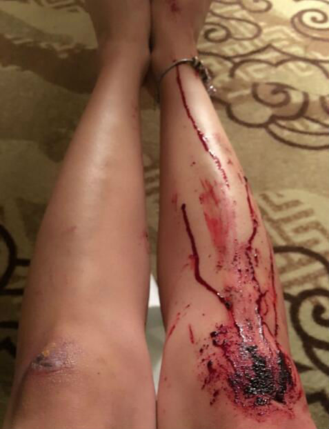 娱乐 > 正文     3月31日,李念在微网志上发出一组腿部受伤图片,照片