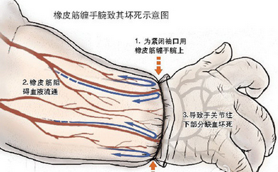 女童手腕長橡皮筋 為何近4年都沒發現?（組圖）