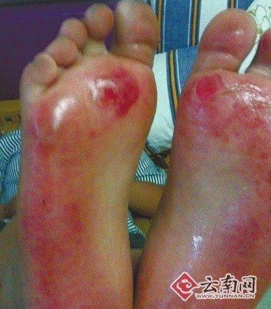 小學生高溫被罰光腳跑步 腳底灼傷紅腫潰爛令人心疼(組圖)