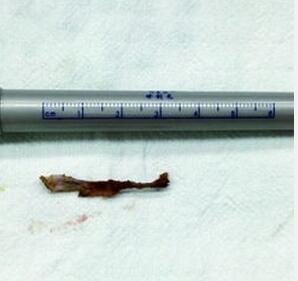 男孩腹中藏針6年 針的來歷成疑問（組圖）