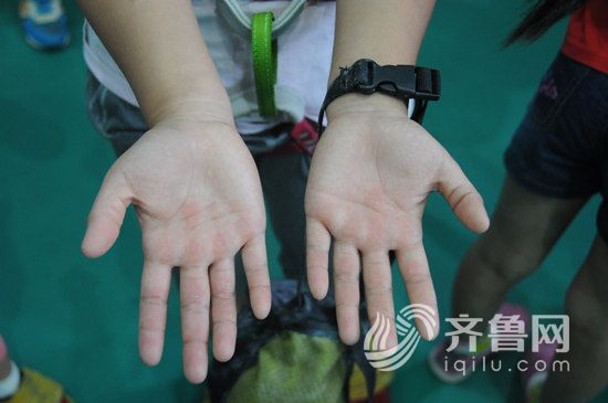 小選手一諾的手上每一個指頭都被磨出了硬繭，但傷痛無礙孩子們對攀岩的喜愛