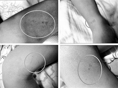 北京3岁男童全身疑遭针扎10处：老师用针扎的
