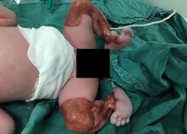 新生儿双腿透明 到底怎么回事？（组图）